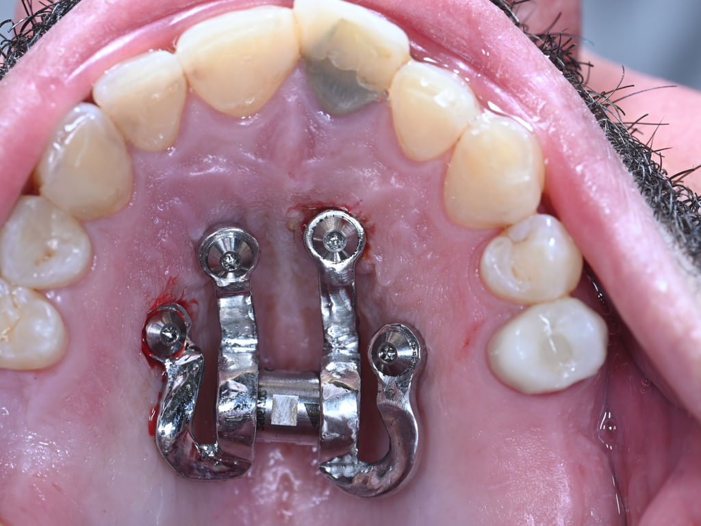 De expander direct na plaatsing op de schroeven.
